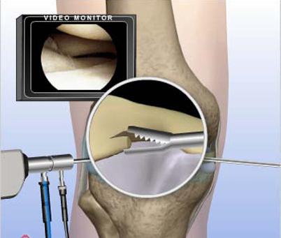 膝关节镜检查诊断优势，膝关节镜检查诊断范围